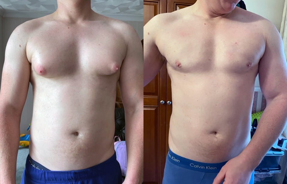 Gynecomastia