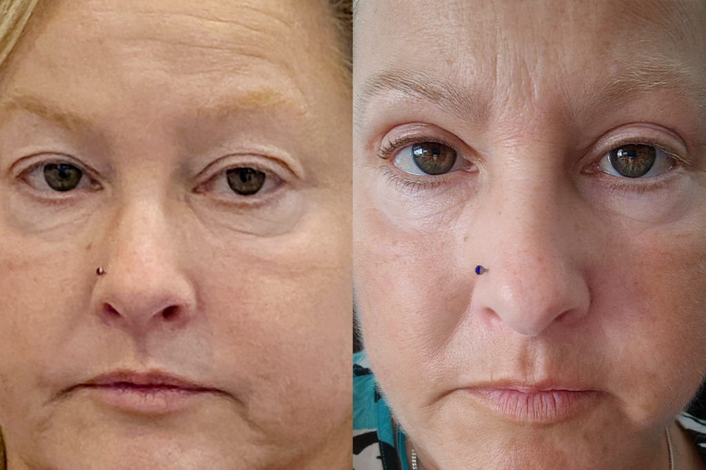 Upper-Blepharoplasty