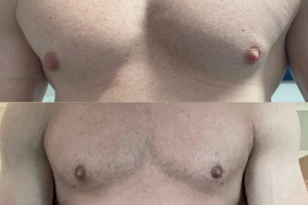 Gynecomastia with Liposuction Gynecomastia with Liposuction