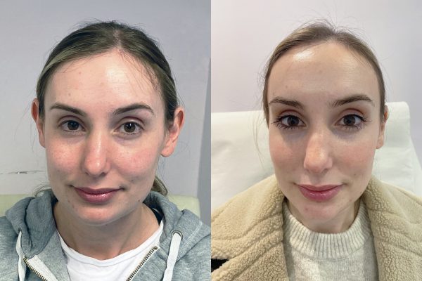 Otoplasty 2 Otoplasty 2